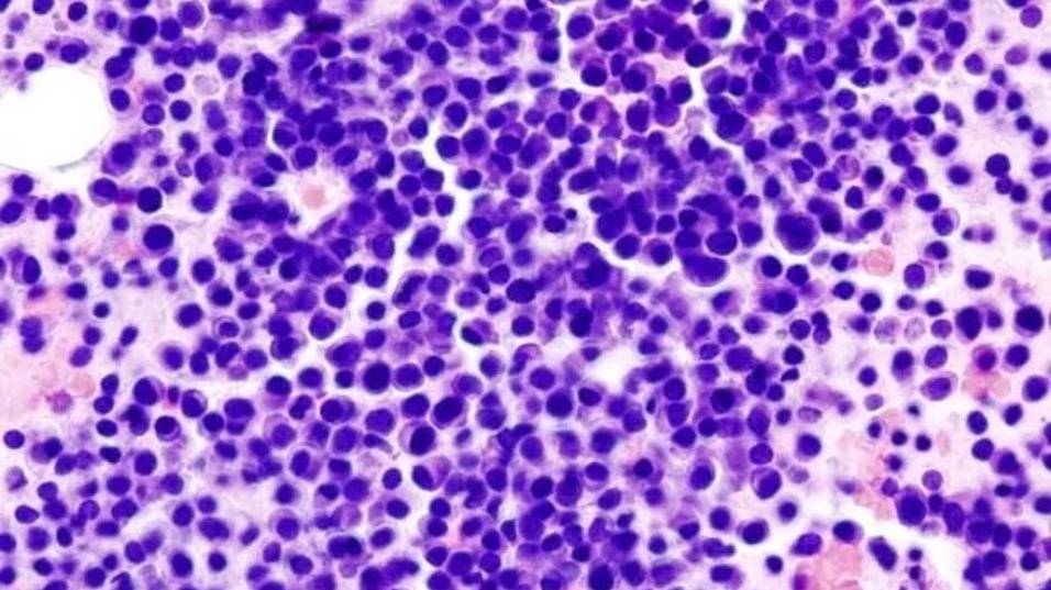 ANMAT aprueba un tratamiento para mieloma múltiple