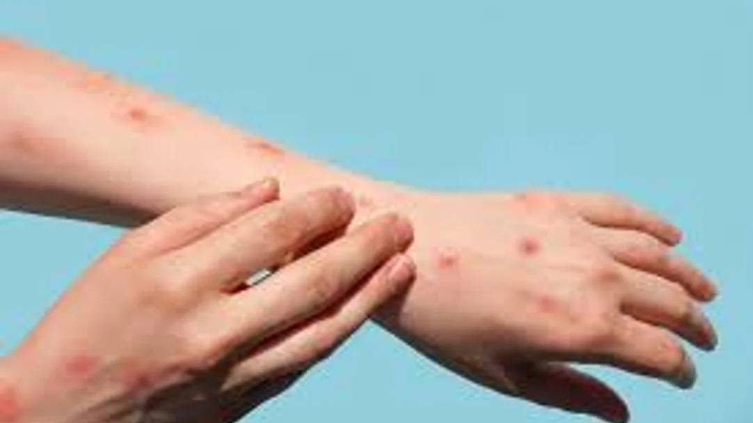 Confirmaron un nuevo caso de Mpox: ¿qué es y cómo se contagia?