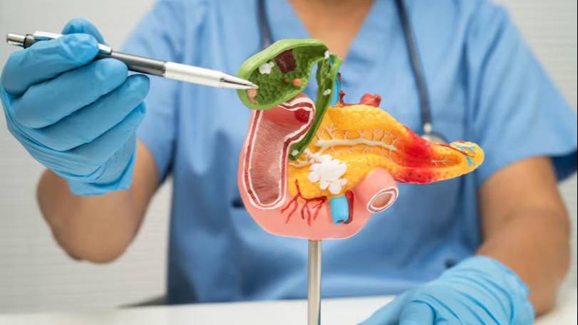 Avances contra el cáncer de páncreas: una terapia dirigida lograría duplicar la supervivencia
