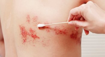 El herpes zóster afecta cada vez a más adultos mayores y genera preocupación médica por sus secuelas