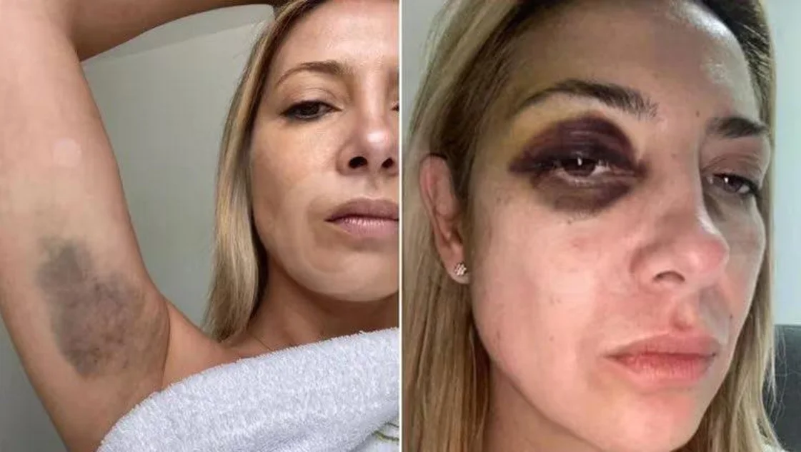 Denuncia contra Alberto Fernández: se filtraron fotos de Fabiola Yáñez golpeada Denuncia contra Alberto Fernández: se filtraron fotos de Fabiola Yáñez golpeada